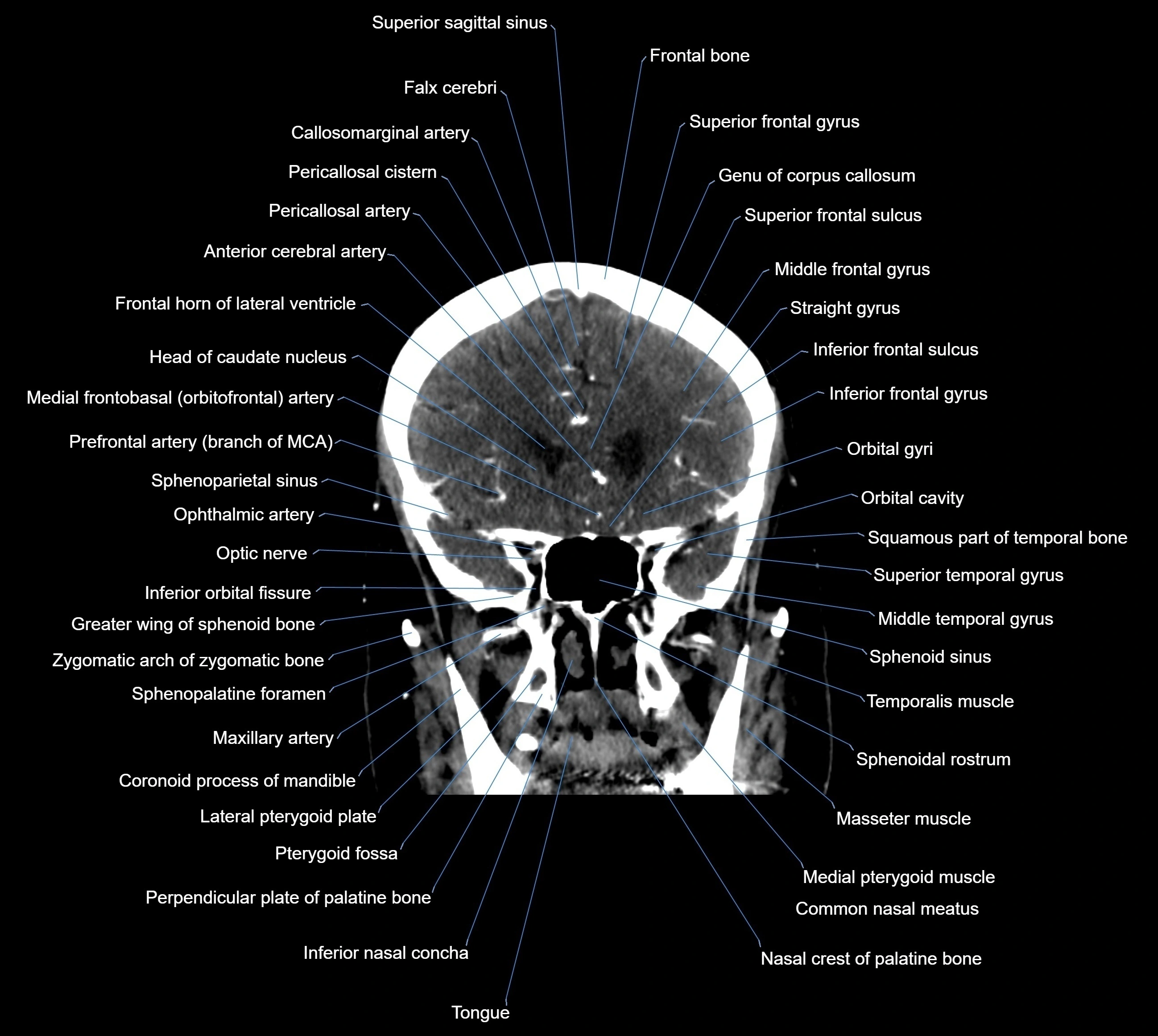 CT Brain coronal cross sectional radiology anatomy image  -img-00001-017.webp